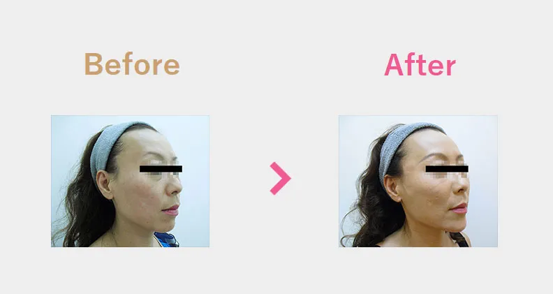 Before After（斜め前）