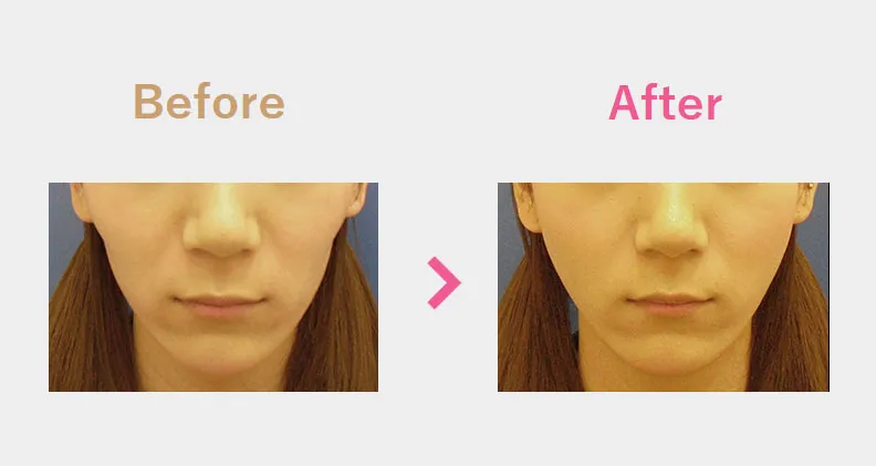 Before After（前）