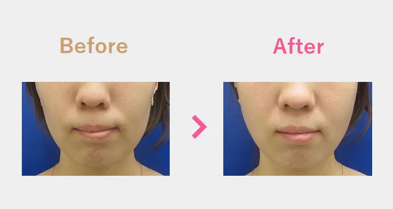 Before After（前）