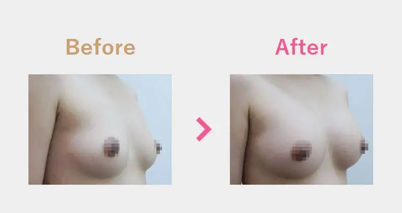 Before After（横）