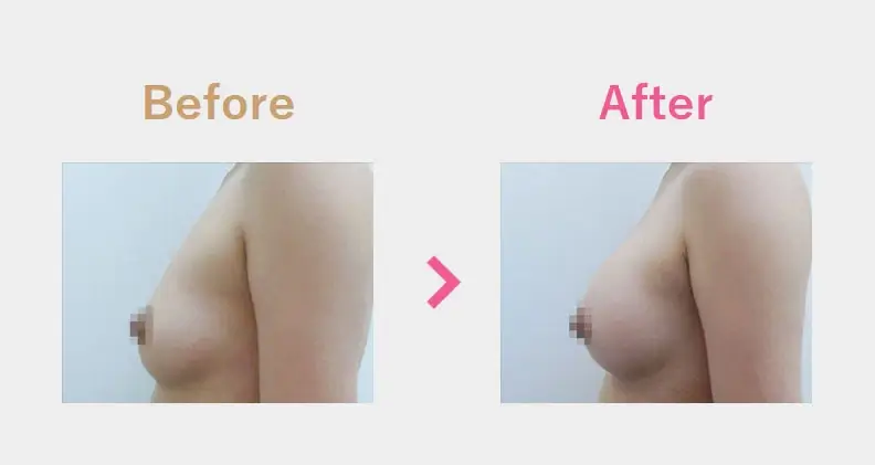 Before After（横）
