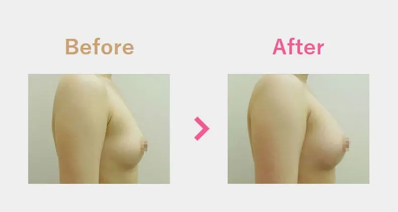 Before After（横）