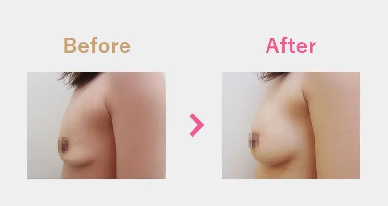 Before After（横）