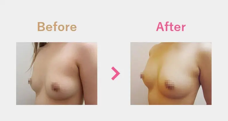 Before After（横）