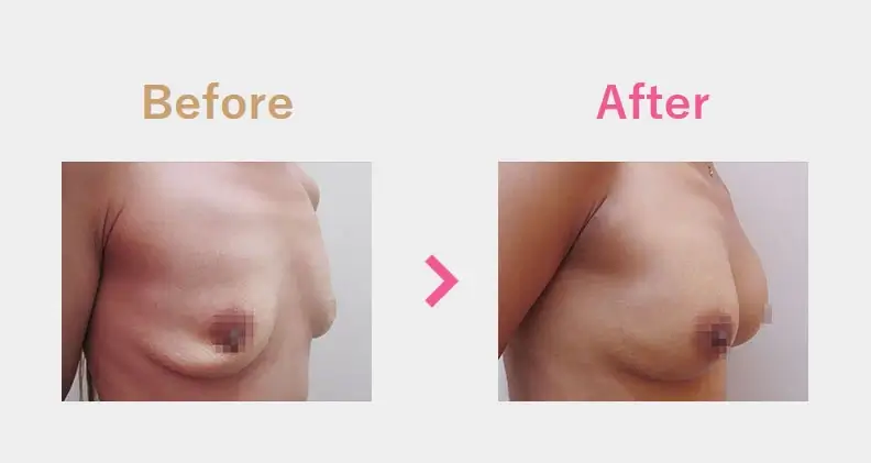 Before After（横）