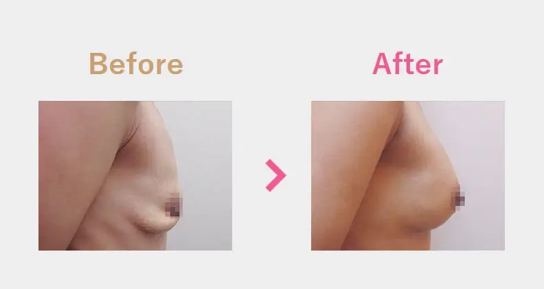 Before After（横）