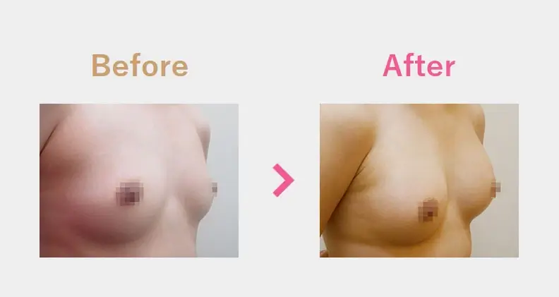 Before After（横）