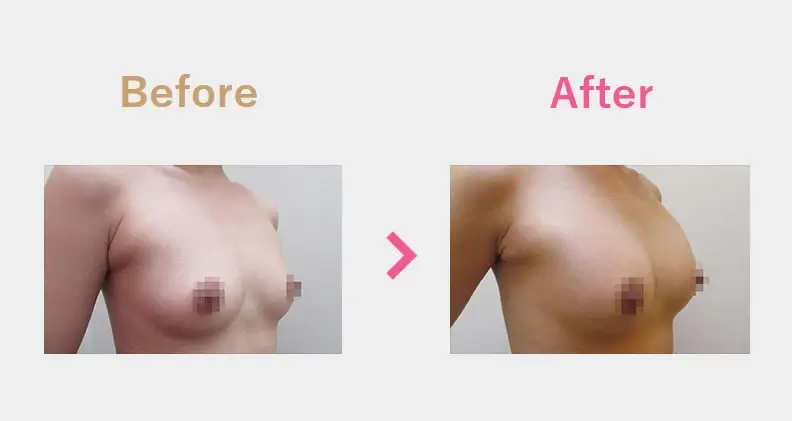 Before After（横）