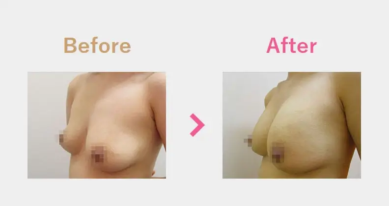 Before After（横）