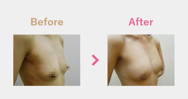 Before After（横）