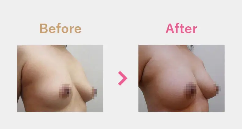 Before After（横）