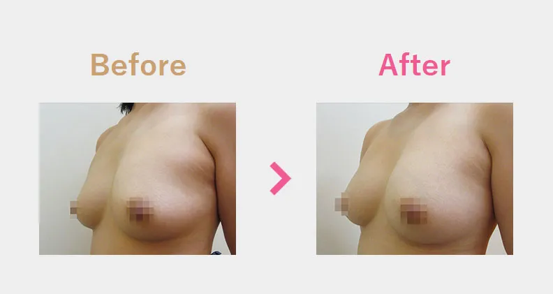 Before After（横）