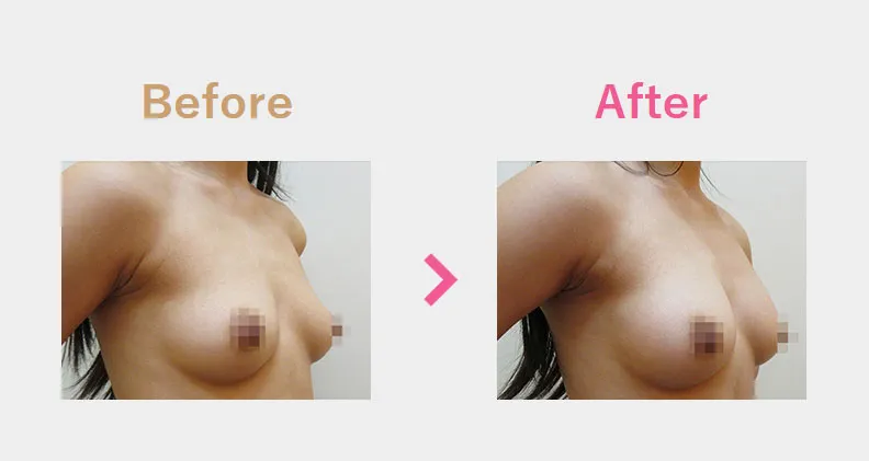 Before After（横）