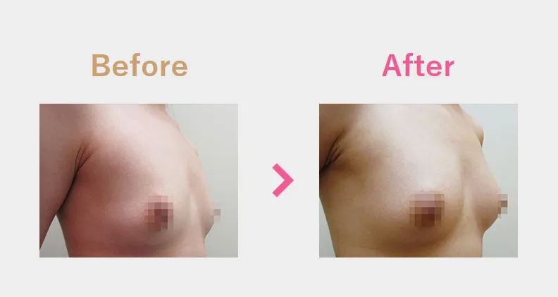 Before After（横）