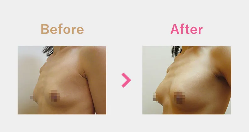 Before After（横）