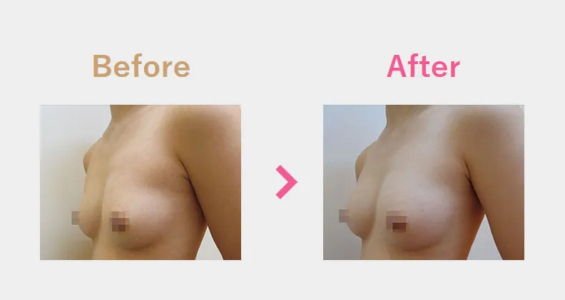 Before After（横）