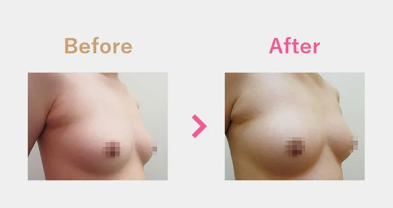 Before After（横）