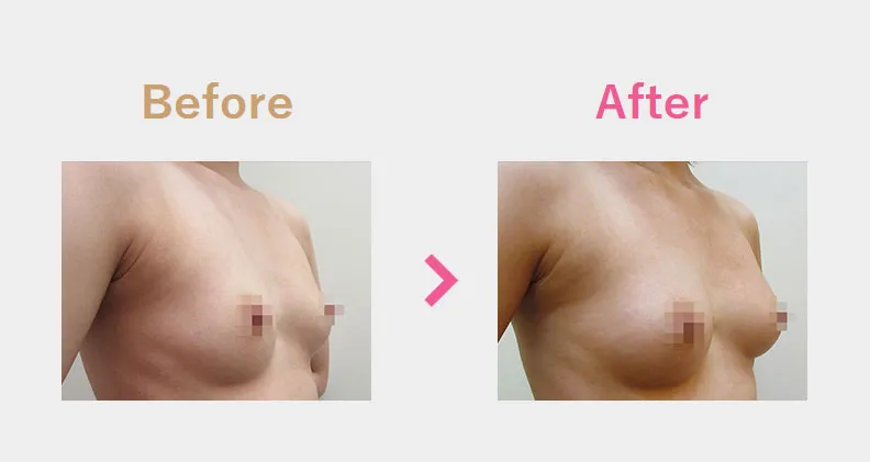 Before After（横）