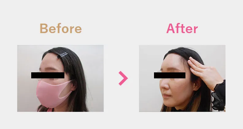 Before After（斜め）
