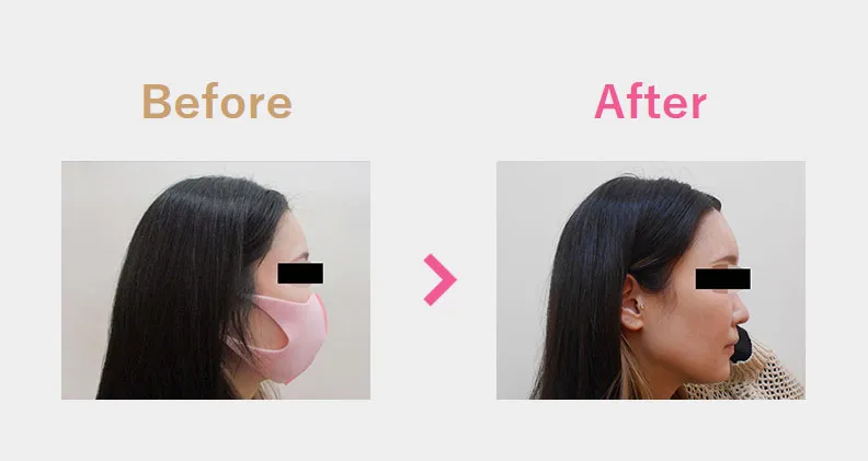 Before After（横）