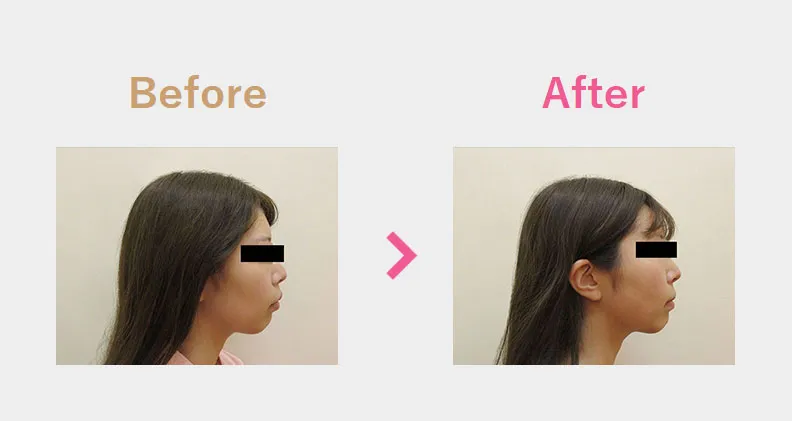Before After（横）