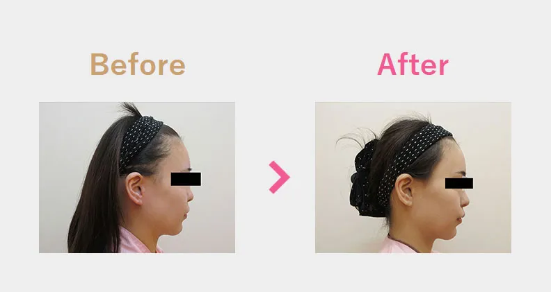 Before After（横）