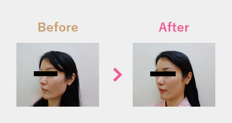 Before After（斜め）