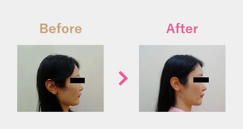 Before After（横）