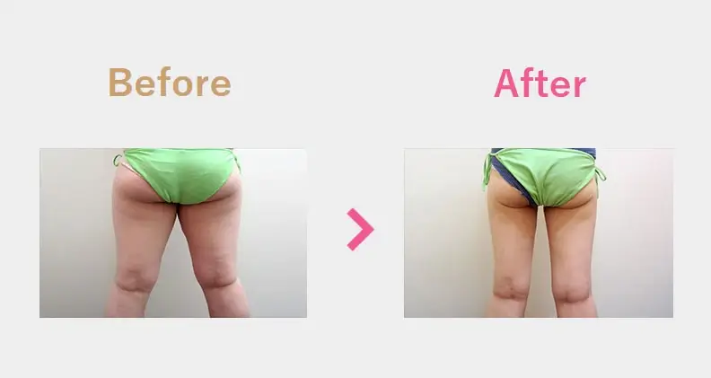 Before After（後）