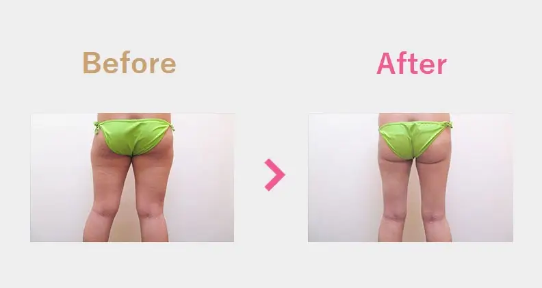 Before After（後）