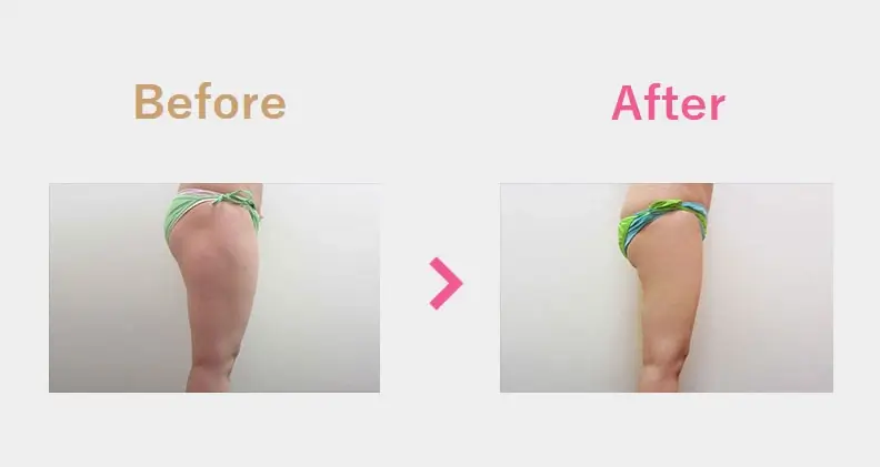Before After（横）