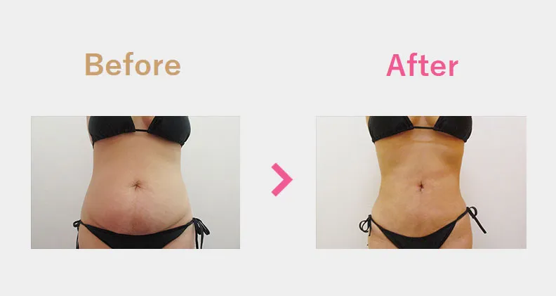 Before After（前）