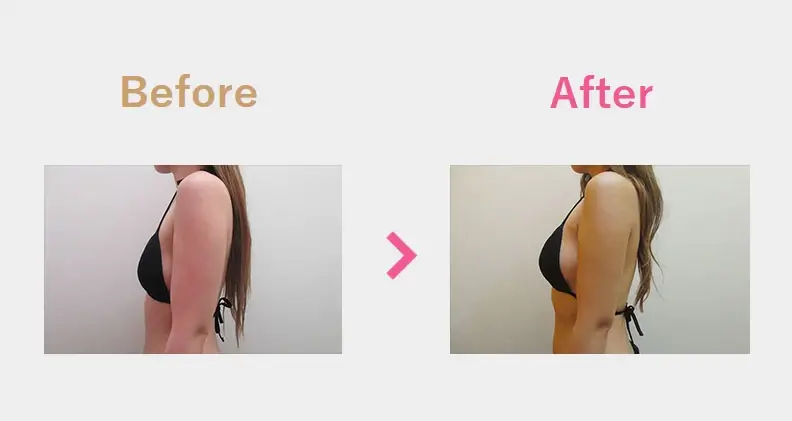 Before After（横）