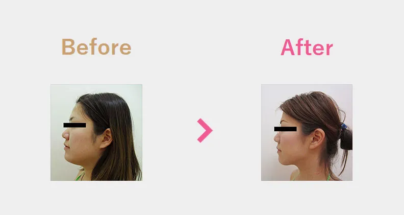 Before After（横）