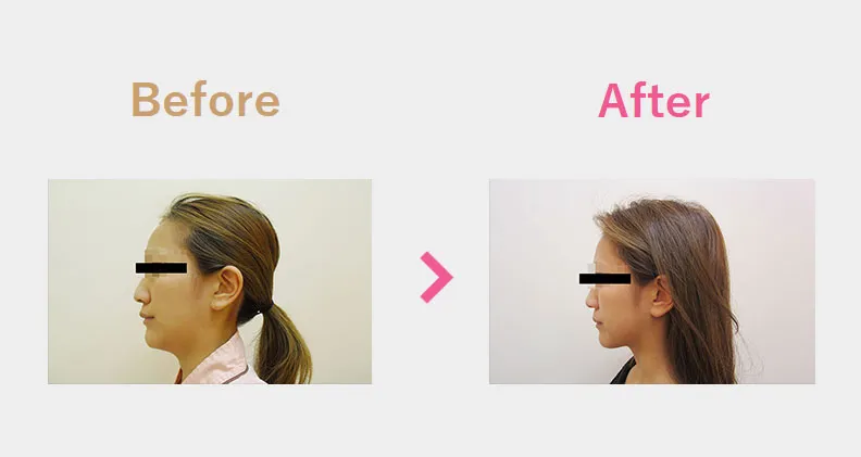Before After（横）