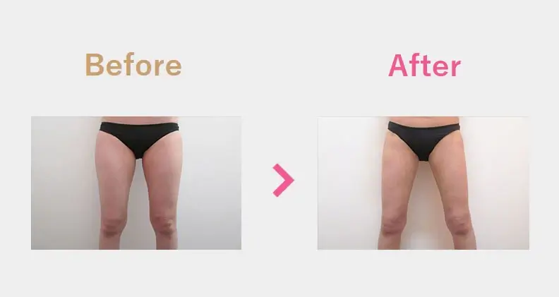 Before After（正面）