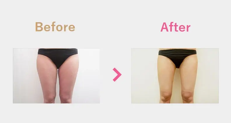 Before After（正面）