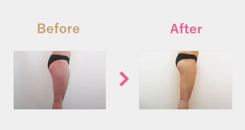 Before After（横）