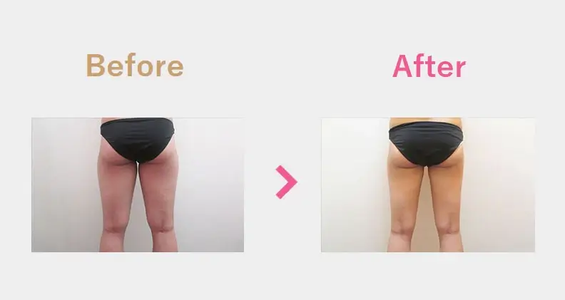 Before After（後）