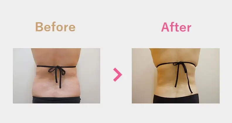 Before After（後）