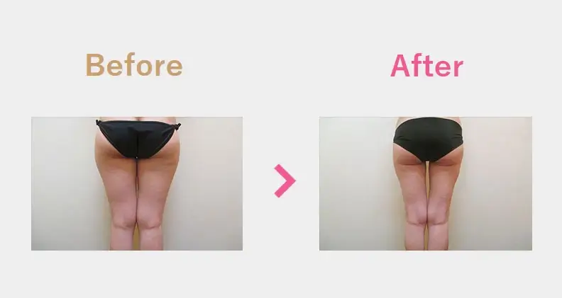 Before After（後）