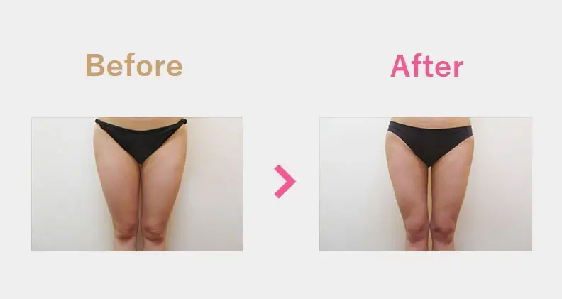 Before After（正面）