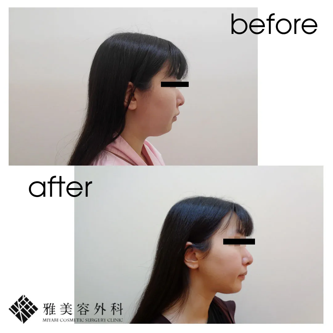 Before After（横）