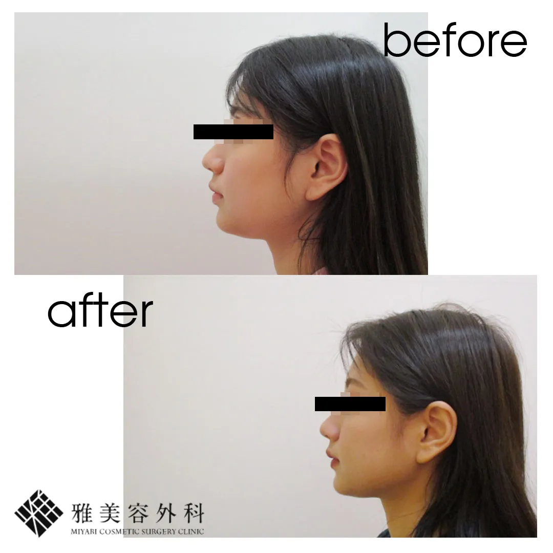 Before After（横）