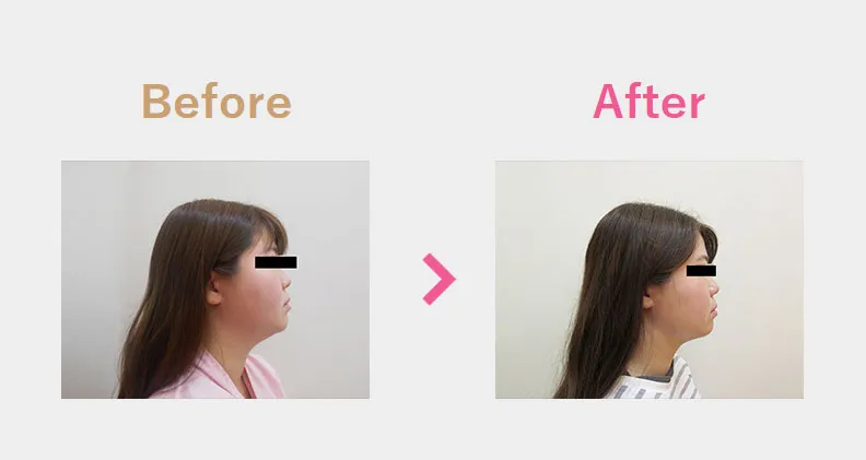 Before After（横）