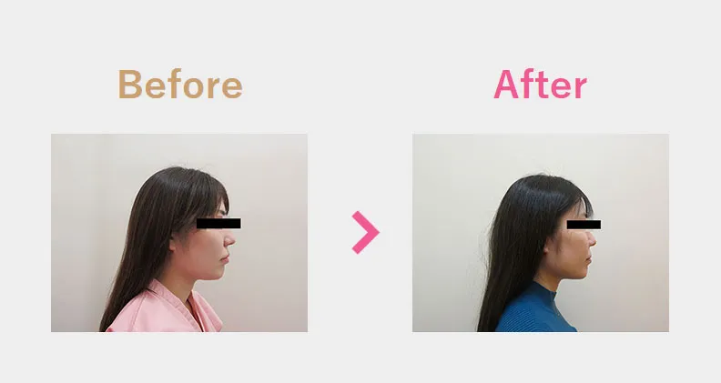 Before After（横）