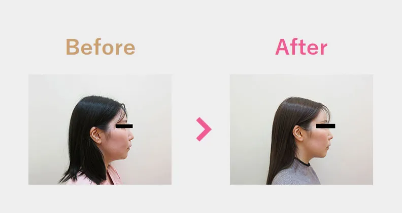Before After（横）