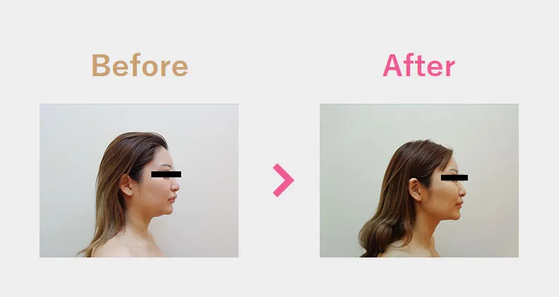Before After（横）