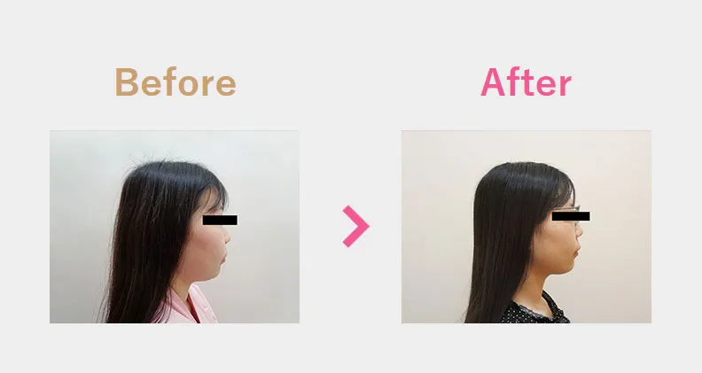 Before After（横）