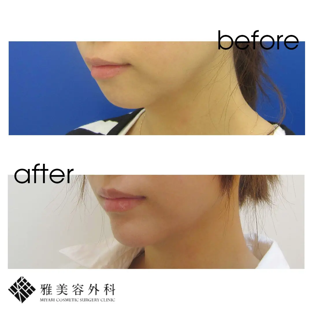 Before After（斜め）